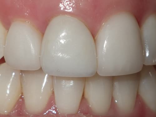 Tooth Replacement After